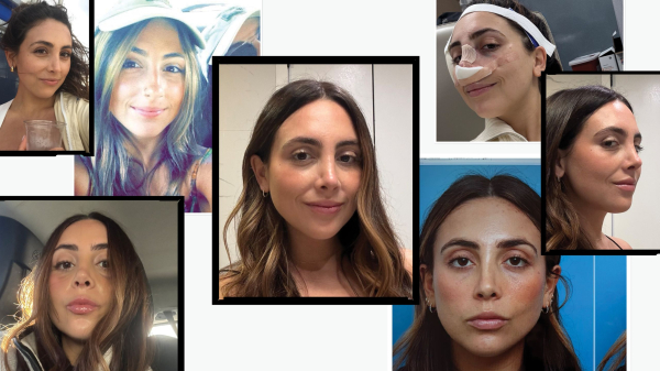 photo collage of a woman before during and after two rhinoplasty surgeries