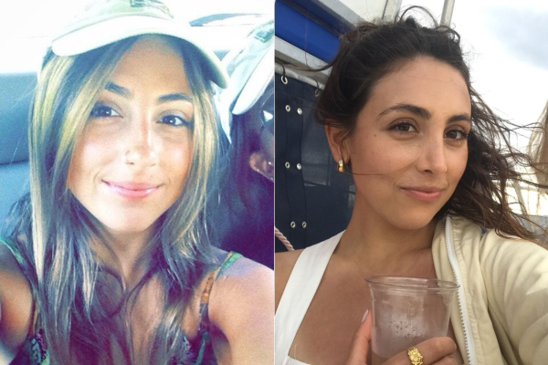 selfies of a woman before and one year after a rhinoplasty
